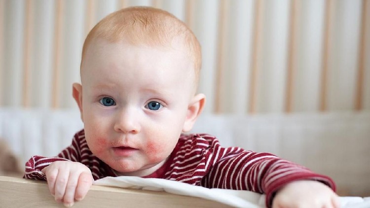 Allergies, atopic dermatitis on the face of a baby