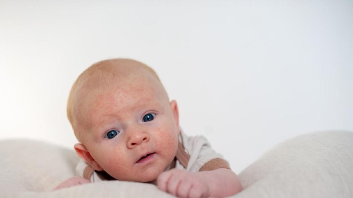 Allergies, atopic dermatitis on the face of a baby