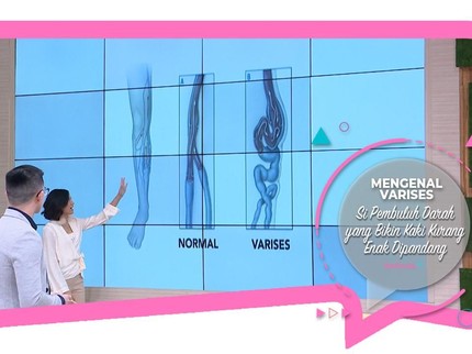 Mengenal Varises, Si Pembuluh Darah yang Bikin Kaki Kurang Enak Dipandang