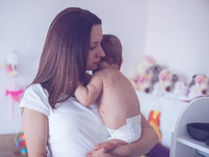 Beda Campak, Cacar Air, Roseola & Rubella pada Anak, Bunda Mesti Tahu