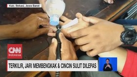 VIDEO: Terkilir, Jari membengkak Cincin Sulit Dilepas