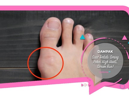 Dampak Saat Terlalu Sering Pakai High Heels, Seram Bun!