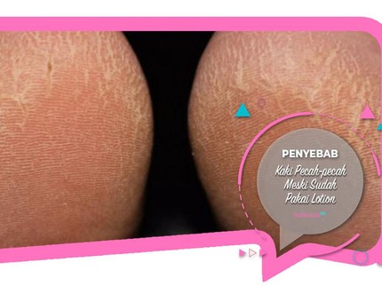 Penyebab Kaki Pecah-pecah Meski Sudah Pakai Lotion