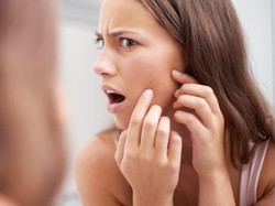 9 Cara Menghilangkan Bekas Jerawat yang Hitam Secara Alami