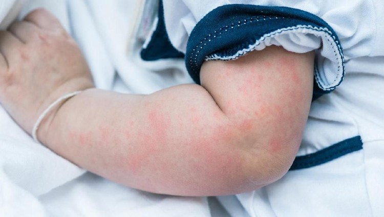 Ilustrasi biang keringat Close up image of baby skin texture suffering severe urticaria, nettle rash.