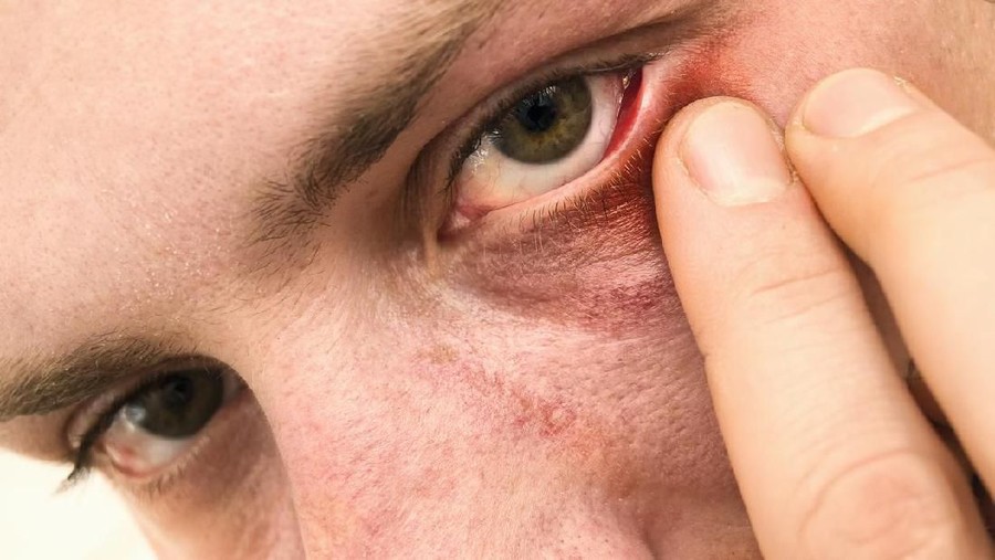 Close up shot of infected eyelid, selective focus

[url=https://www.istockphoto.com/search/lightbox/12059314#633a202] [img]https://content22-foto.inbox.lv/albums187686196/grebiss/11-03-2012/eye-stye.jpg[/img][/url]
