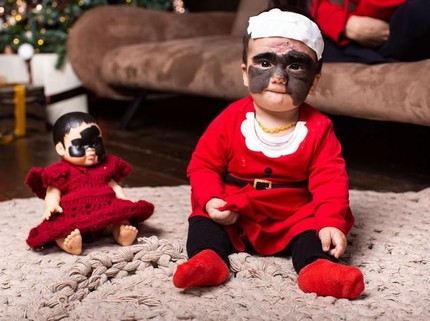 Takjub! Operasi Tanda Lahir 'Batman' di Wajah Bayi Ini Tanpa Bekas Luka