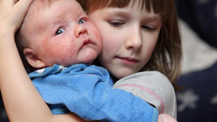 biang keringat The girl embraces her sick brother with eczema