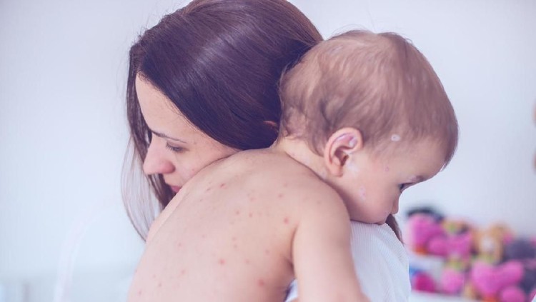 Campak sangat menular pada anak, itu sebabnya penting dilakukan vaksin rubella agar tidak menyebarkan hingga menjadi wabah.