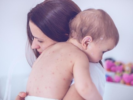 Pentingnya Vaksin Rubella Cegah Penularan Wabah Campak pada Anak