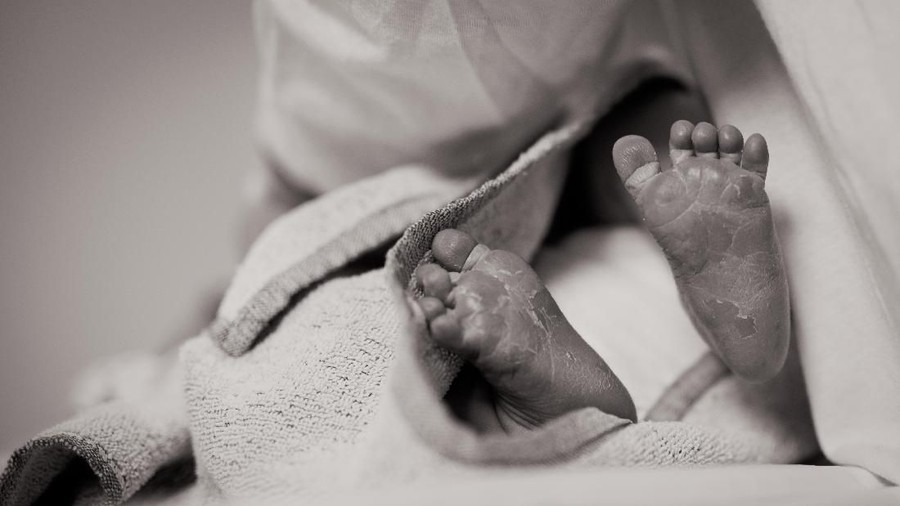 Si bayi mengalami kebocoran darah di daerah sumsum tulang belakang. 