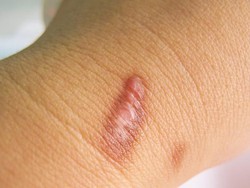 Pria di Cilegon Keluhkan Keloid di Leher usai Memancing, Kok Bisa?