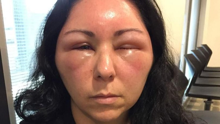 Reaksi alergi akibat pewarna rambut membuat wajah wanita ini bengkak. Hati-hati bahayanya ya, Bunda.