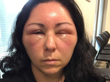 Duh! Pakai Pewarna Rambut, Wajah Wanita Ini Bengkak Sampai Susah Melek