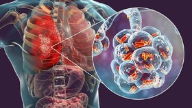 Mengenal Pneumonia Bilateral, Diidap Paus Fransiskus Sebelum Meninggal