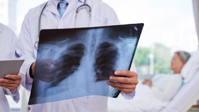Pada pasien infeksi virus corona baru atau Covis-19, hasil CT scan paru-paru akan memperlihatkan bercak putih seperti pecahan kaca yang menyebar.
