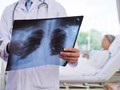 AS Peringatkan Warganya Soal Pneumonia Misterius di China