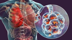 Dokter Paru: Imun Kuat Kunci Cegah Pneumonia Wuhan