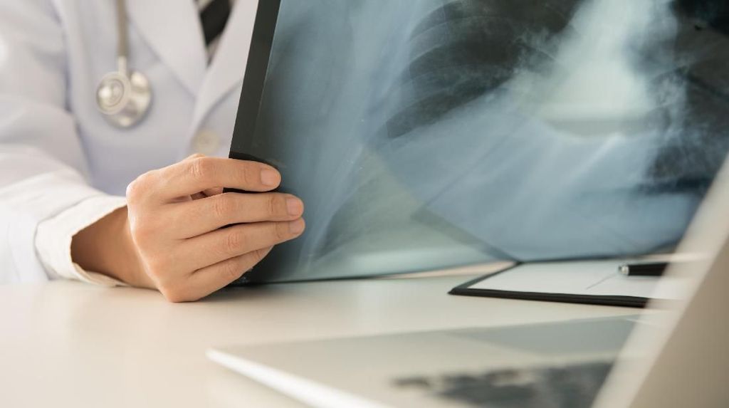 IDAI Sebut Campak Bisa Sebabkan Pneumonia hingga Radang Otak