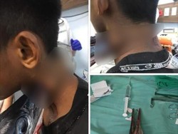 Moncong Marlin Menancap 2 Hari di Leher Bocah, Dokter: Untung Tak Dilepas