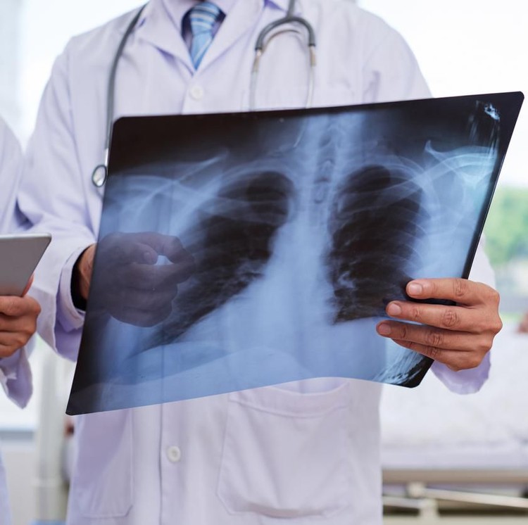 ilustrasi pneumonia Chest x-ray in hands of medical worker