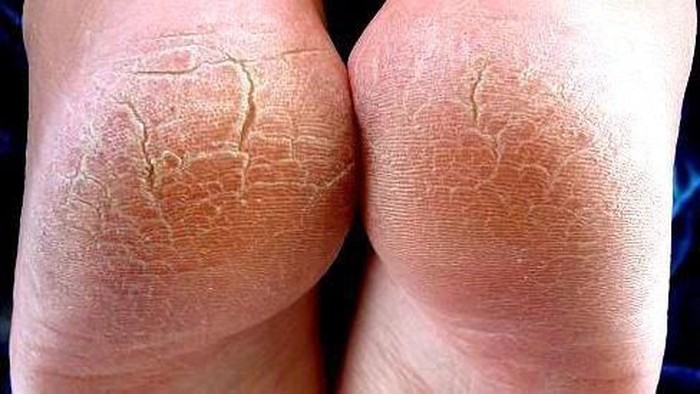 Cara Alami Mengatasi Kaki dan Tumit Pecah