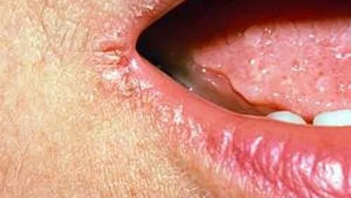 Apakah Mulut Kering Merupakan Penyebab Bau Mulut?