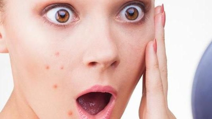 Perawatan Wajah Berjerawat Tidak Boleh Sembarangan, Pilih Toner Wajah untuk Kulit Berjerawat yang Tepat