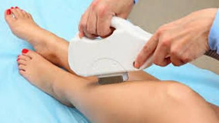 Kekurangan Metode Laser Hair Removal untuk Menghilangkan Bulu
