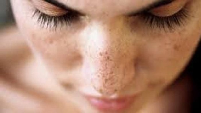 Flek Hitam Membandel? Ini Solusinya