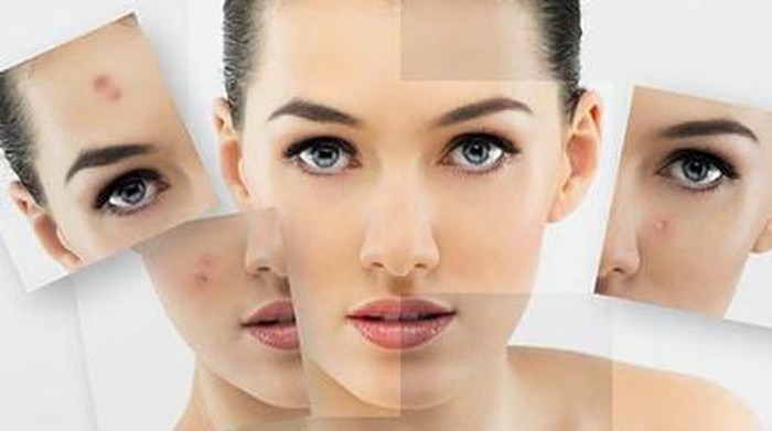 Kelebihan Laser Jerawat untuk Menghilangkan Flek Hitam