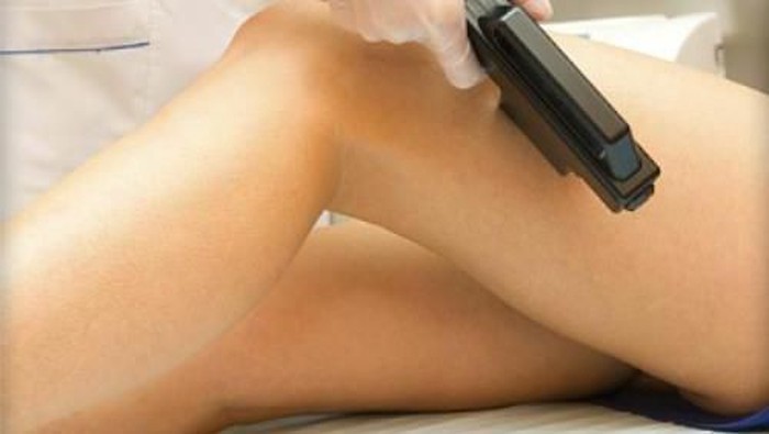 Cara Menghilangkan Bulu Kaki Dengan Laser
