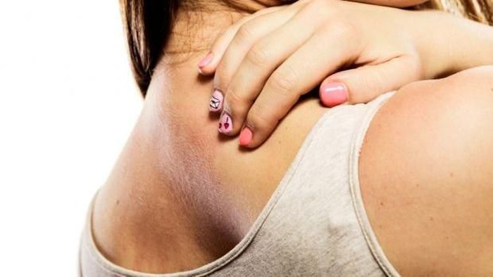 Atasi Bintik Merah Pada Kulit Dengan Obat Biang Keringat Berikut