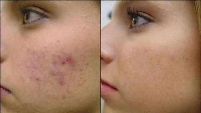 Serum Wajah untuk Kulit Berjerawat Dengan Vitamin C