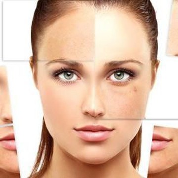 Cara Menghilangkan Bekas Jerawat Punggung dengan Bahan Alami
