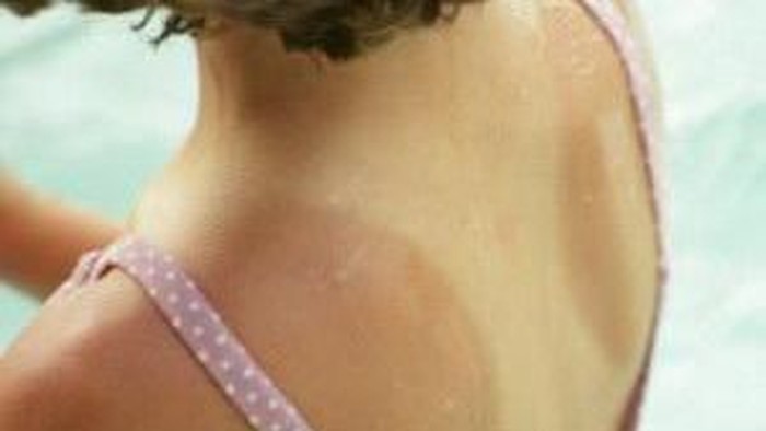 Cara Mudah Menghilangkan Warna Belang Pada Kulit