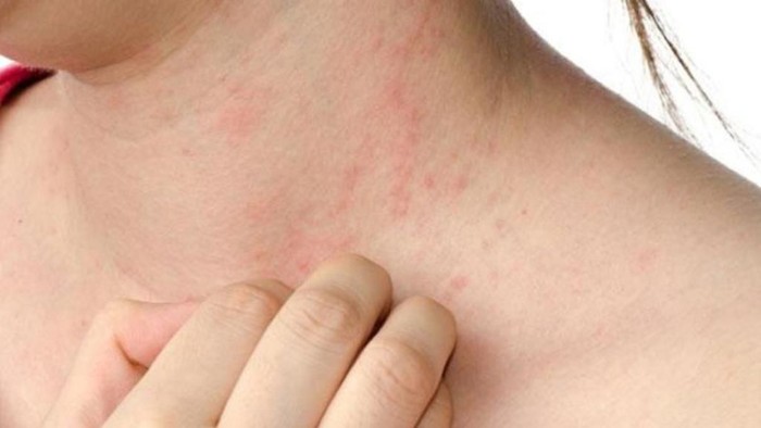 Obat Biang Keringat Tradisional untuk Orang Dewasa