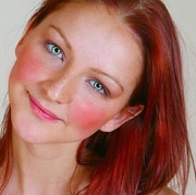 Sering Muncul Warna Kemerahan Pada Wajah? Waspadai Rosacea!