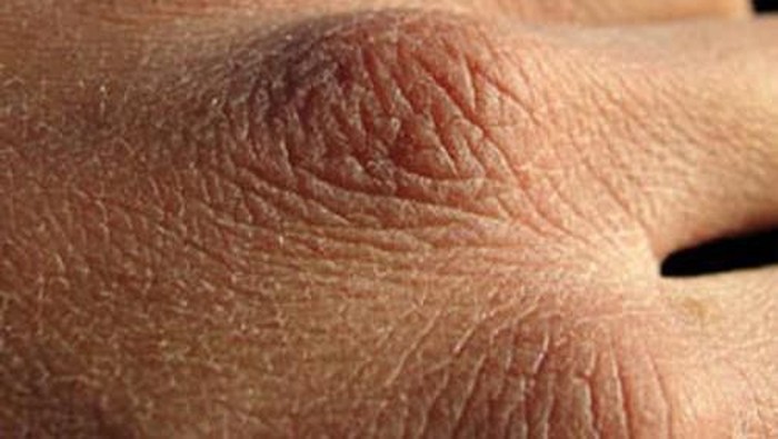 Penyebab Kulit Kering dan Kusam