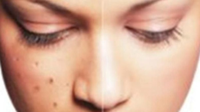 Inilah 5 Penyebab Flek Hitam Pada Wajah dan Kulit Tubuh