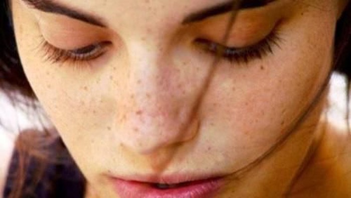 Penyebab Flek Hitam dan Kaitannya dengan Faktor Genetik