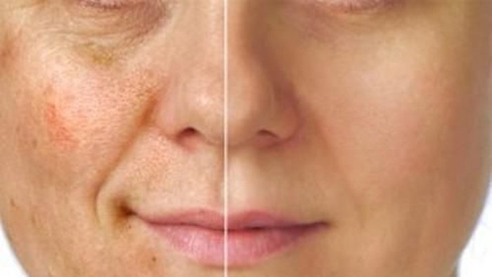 Bisakah Penyakit Menjadi Penyebab Timbulnya Flek Hitam di Tubuh?