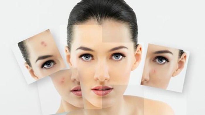 Berbagai Mitos Mengenai Jerawat