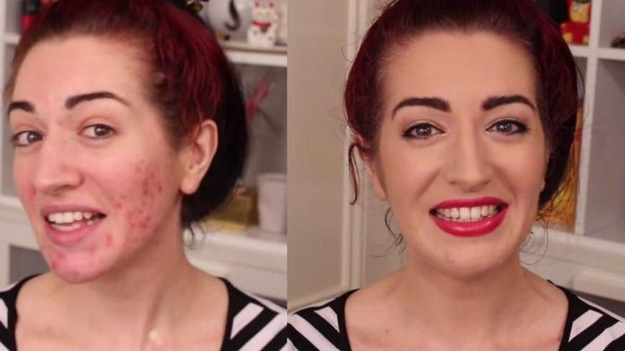 Ternyata Begini Langkah-Langkah yang Benar untuk Menutupi Jerawat dengan Makeup Ternyata Begini Langkah-Langkah yang Benar untuk Menutupi Jerawat dengan Makeup