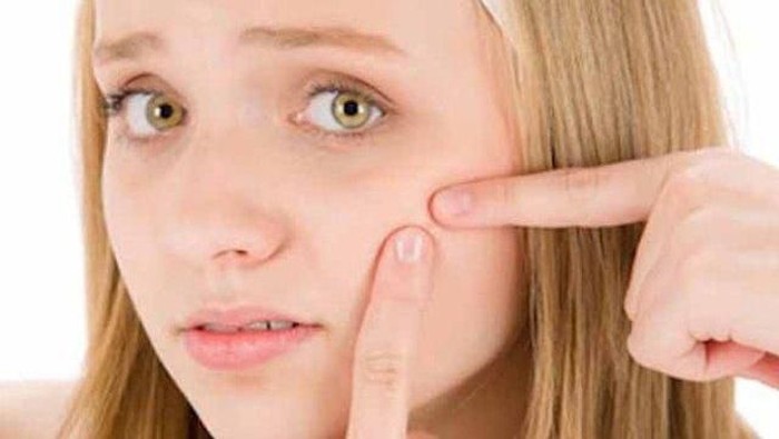 Tips Menghilangkan Jerawat Dengan Bumbu Rempah-Rempah