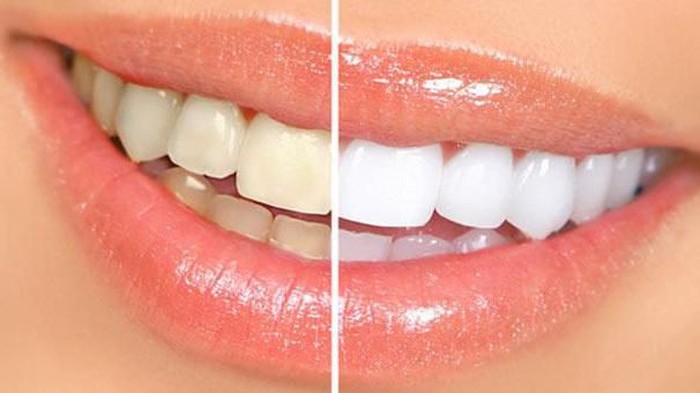 Cara Terbaik Memutihkan Gigi
