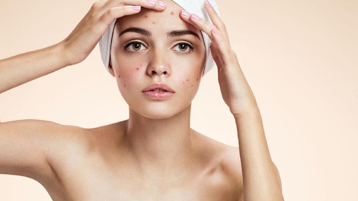 4 Hal yang Menjadi Musuh Utama Ketika Wajah Kamu Sedang Berjerawat
