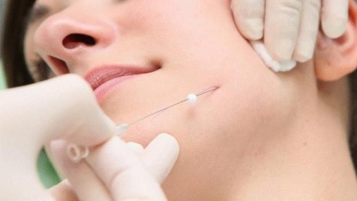 Mau Coba Perawatan Tanam Benang di Wajah? Jangan Abaikan Do's dan Don'ts Berikut Ini!