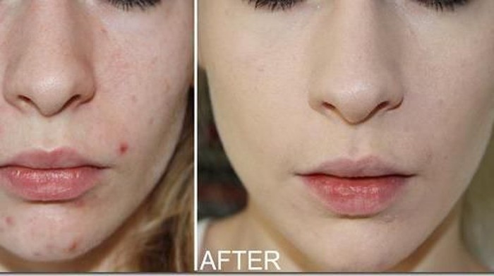 Primer Bisa Menyebabkan Jerawat? Ini Seluk Beluk Primer yang Perlu Kamu Pahami!