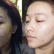 Contek Tips Jitu Halau Jerawat Menjelang Menstruasi